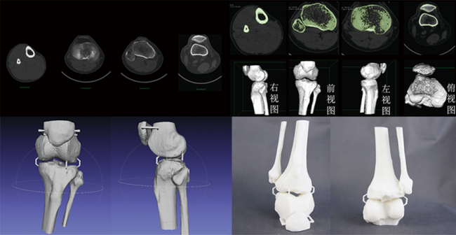 CT數(shù)據(jù)三維重建骨骼模型，骨骼模型精細化建模修復，骨骼模型3D打印快速成型