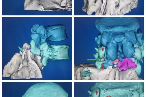 3D打印制作脊柱模型，可以讓更加直觀、立體地了解患者的病情，并制定相應(yīng)的手術(shù)方案或者矯正治療方案。.webp