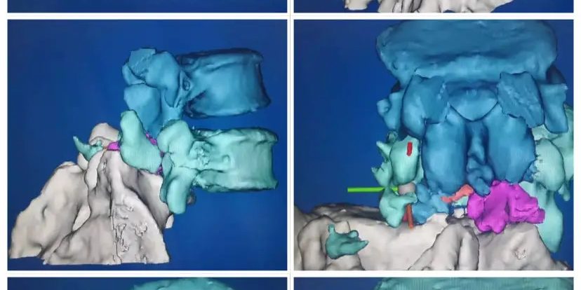 3D打印制作脊柱模型，可以讓更加直觀、立體地了解患者的病情，并制定相應的手術方案或者矯正治療方案。.webp