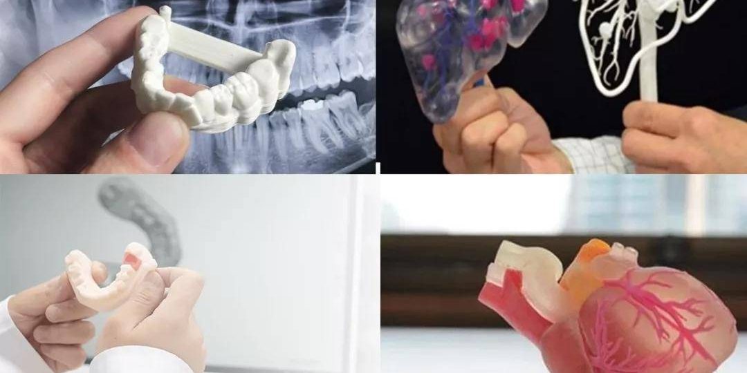 CT數(shù)據(jù)三維重建，醫(yī)學(xué)3D打印技術(shù)在骨科中的具體應(yīng)用